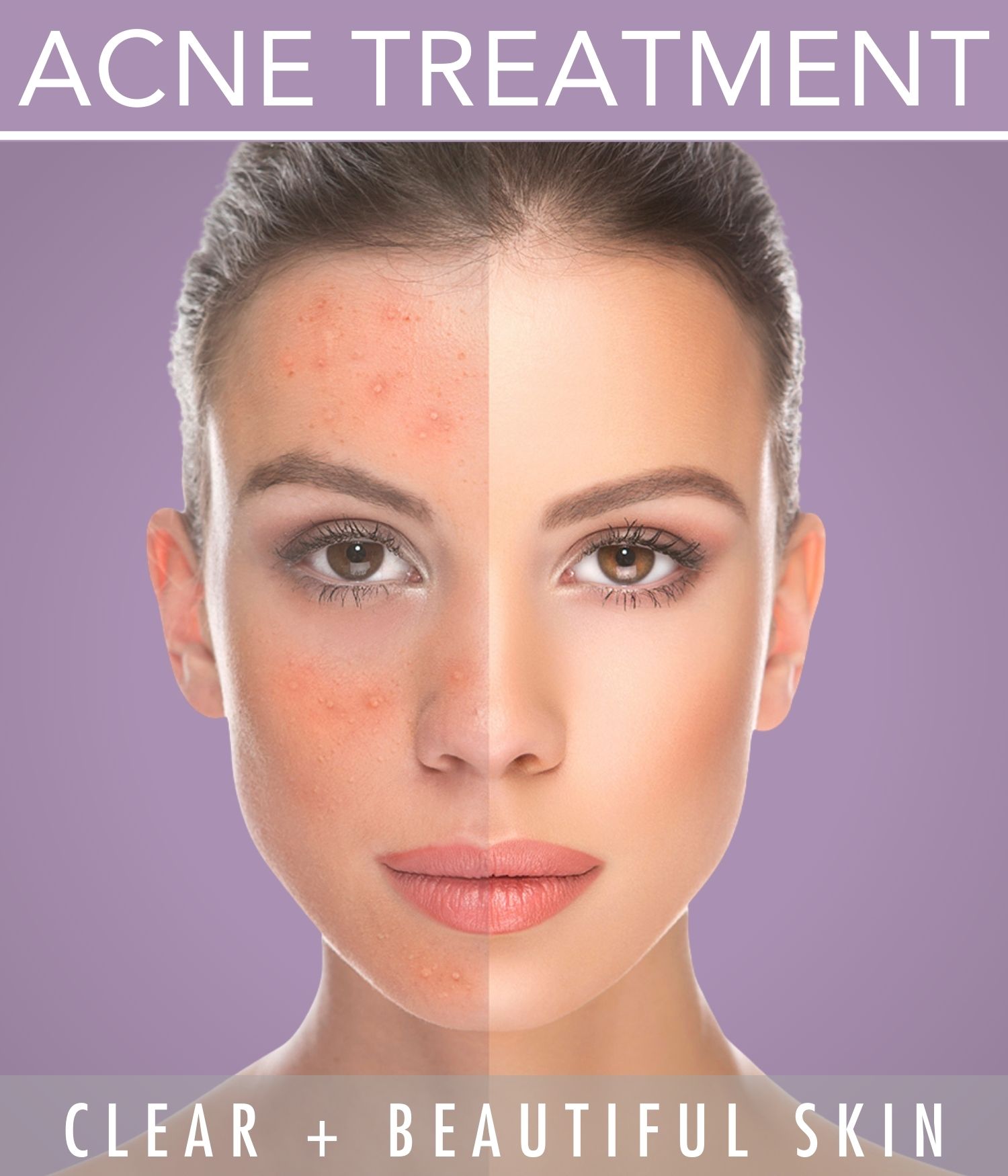 Anti-Acne Cream Manufacturer in India